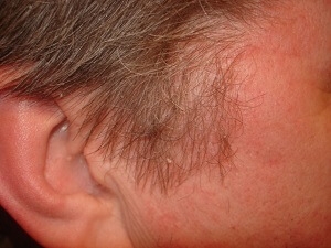 khronicheskie-dermatozy-kozhi-golovy-kak-razlichat-i-chem-lechit