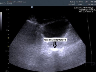 khronicheskij-prostatit-mozhet-grozit-obrazovaniem-kamnej-v-prostate