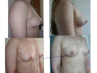 klinicheskie-sluchai-primeneniya-protsedury-lipofilinga