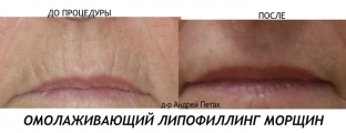 klinicheskie-sluchai-primeneniya-protsedury-lipofilinga