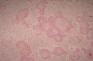 kogda-postanovka-diagnoza-toksikodermii-opravdana