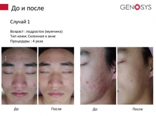 kogda-svetoizluchenie-polezno-dlya-kozhi-fototerapiya-s-lampoj-geno-led
