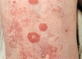 koltsevidnye-porazheniya-kozhi-kak-pravilno-postavit-diagnoz