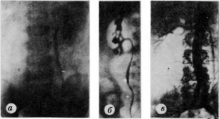 kompleksnyj-podkhod-k-diagnostike-pochechnoj-arterialnoj-gipertenzii