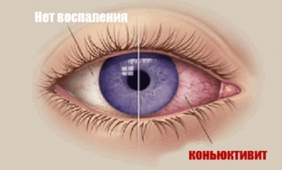 kon-yunktivit-chto-neobkhodimo-znat-o-prirode-etogo-zabolevaniya