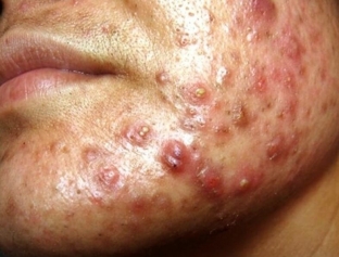 konglobatnye-ugri-simptomy-i-lechenie-tyazheloj-formy-ugrevoj-bolezni