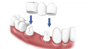 koronki-na-osnove-dioksida-tsirkoniya-tochnost-estetichnost-dolgovechnost