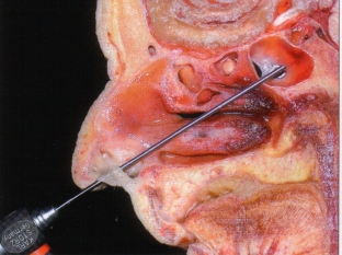 korotko-o-glavnom-simptomy-i-lechenie-sfenoidita