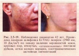 korrektsiya-involyutsionno-distroficheskikh-izmenenij-kozhi-metodom-lazernoj-shlifovki