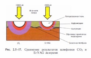 korrektsiya-involyutsionno-distroficheskikh-izmenenij-kozhi-metodom-lazernoj-shlifovki