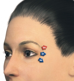 korrektsiya-morshchin-periorbitalnoj-oblasti-effektivnyj-preparat-juv-derm-volbella-tm