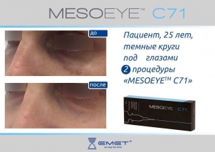 korrektsiya-temnykh-krugov-i-otechnosti-mekhanizm-dejstviya-i-rezultaty-primeneniya-preparata-mesoeye