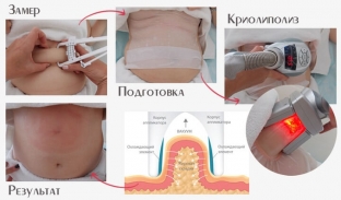 kriolipoliz-i-vosstanavlivayushchie-niti-dlya-korrektsii-figury