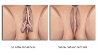 labioplastika-malenkaya-operatsiya-s-bolshimi-rezultatami