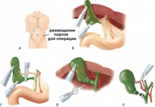 laparoskopichekaya-kholetsistektomiya-pomozhet-vylechit-zhelchnokamennuyu-bolezn