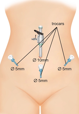 laparoskopiya-kak-metod-diagnostiki-i-lecheniya-v-ginekologii