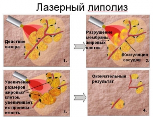 lazernaya-liposaktsiya-populyarnaya-novinka-v-borbe-s-zhirom