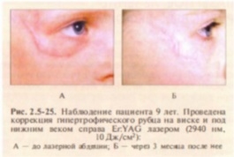 lazernoe-lechenie-rubtsovykh-deformatsij-kozhi