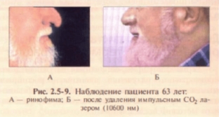 lazernye-tekhnologii-v-lechenii-dobrokachestvennykh-novoobrazovanij-kozhi