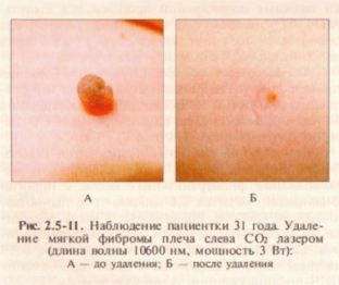 lazernye-tekhnologii-v-lechenii-dobrokachestvennykh-novoobrazovanij-kozhi