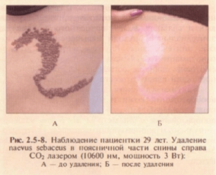 lazernye-tekhnologii-v-lechenii-dobrokachestvennykh-novoobrazovanij-kozhi