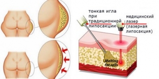 lazernyj-lipoliz-ili-gollivudskaya-liposaktsiya-sovremennyj-metod-udaleniya-zhirovykh-otlozhenij