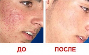 lechenie-akne-pochemu-patsienty-predpochitayut-lazernuyu-terapiyu