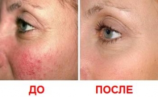 lechenie-akne-pochemu-patsienty-predpochitayut-lazernuyu-terapiyu