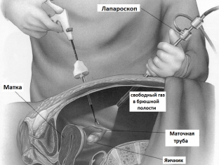 lechenie-apopleksii-yaichnika-chto-delat-esli-yaichnik-vas-podvel