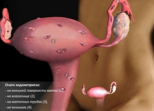 lechenie-endometrioza-kakie-metody-pomogut-izbavitsya-ot-etoj-patologii