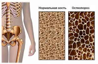 lechenie-osteoporoza-kak-predotvratit-perelomy-kostej