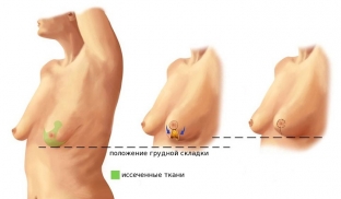 mastoptoz-prichiny-stepeni-i-vidy-korrektsii-obvisaniya-grudi