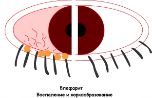metody-lecheniya-blefarita-kak-ustranit-vospalitelnyj-protsess-vek