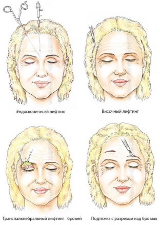 molodogo-vzglyada-pomozhet-dobitsya-lifting-brovej