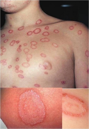 na-chto-pokhozh-strigushchij-lishaj-kak-ne-oshibitsya-v-diagnostike