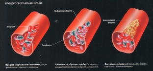 narushenie-svertyvaemosti-krovi-kak-vyyavit-i-nejtralizovat-opasnuyu-patologiyu