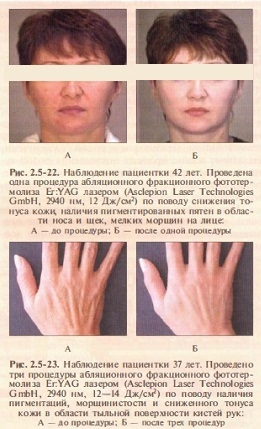 neablyatsionnoe-lazernoe-omolozhenie-kozhi-fraktsionnyj-fototermoliz
