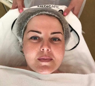 nekhirurgicheskij-lifting-litsa-novyj-protokol-smart-face-lifting-na-osnove-probioticheskoj-karboksiterapii