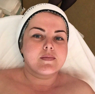 nekhirurgicheskij-lifting-litsa-novyj-protokol-smart-face-lifting-na-osnove-probioticheskoj-karboksiterapii