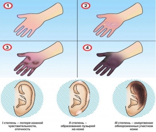 neotlozhnaya-pomoshch-pri-obmorozhenii-simptomy-opredelyayut-taktiku-lecheniya