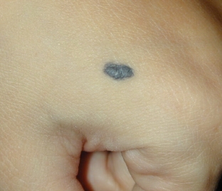 nevus-na-kozhe-opasen-li-goluboj-nevus