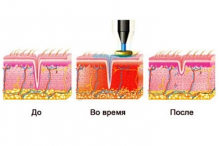 novinki-radiovolnovoj-podtyazhki-litsa-igolchatyj-rf-lifting