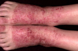 obraz-zhizni-kotoryj-stoit-vybrat-pri-atopicheskom-dermatite