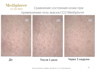 omolazhivayushchij-effekt-neinvazivnoj-karboksiterapii-mediplorer-yaponiya
