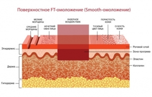 omolozhenie-lazerom-kogda-pod-nozh-lozhitsya-ne-okhota