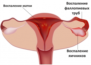 ooforit-prichiny-simptomy-i-lechenie-vospaleniya-yaichnikov