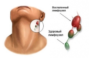 opasnye-oslozhneniya-posle-nepravilnogo-lecheniya-anginy-i-kak-ikh-izbezhat