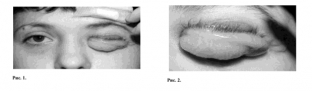 operatsiya-blefaroplastika-pri-nejrofibromatoze-kak-poluchit-krasivyj-stojkij-rezultat
