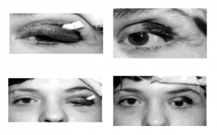 operatsiya-blefaroplastika-pri-nejrofibromatoze-kak-poluchit-krasivyj-stojkij-rezultat