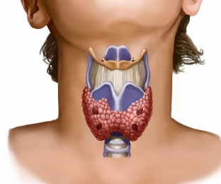 opukhol-shchitovidnoj-zhelezy-kak-ne-propustit-opasnye-simptomy